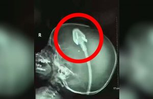 Dječakov rendgen je šokirao doktore diljem svijeta: Sad njegovi roditelji upozoravaju druge! (VIDEO)